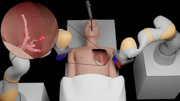 Roboterplattform für die periphere Lungentumorintervention auf Basis magnetischer Tentakel