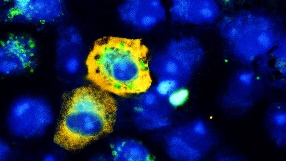 Infiziert SARS-CoV-2 (gelb) Affennierenzellen - drosselt es deren Recycling-Mechanismus: Es finden sich weniger Autophagie-Signale (grün) als in nicht infizierten Zellen. Zellkerne sind blau angefärbt