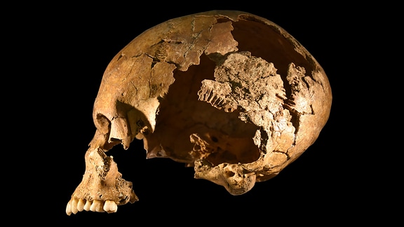 Schädel aus einem Grab der Merowinger-Siedlung Lauchheim "Mittelhofen". Bei diesem toten Jugendlichen konnten gleich drei Infektionen nachgewiesen werden.