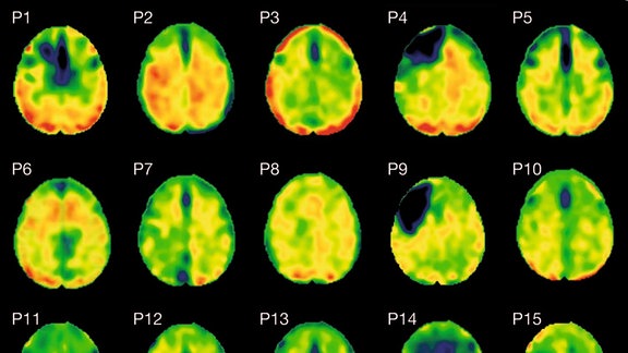 Die Konzentration von Tau-Protein (BP-ND z-Score - blau) im Gehirn von Patienten mit traumatischer Hirnverletzung. Mutationen des Tau-Proteins können zu neurodegenerativen Krankheiten wie Alzheimer führen.