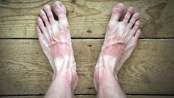 Sonnenbrand auf den Füßen