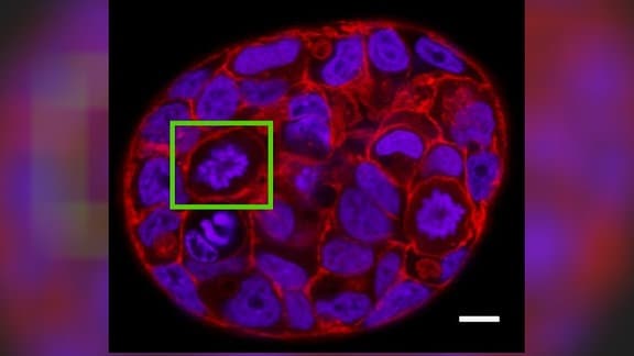 Tumorzelle einer sich teilenden Krebszelle