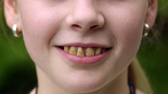 Mädchen mit schlecht gepflegten Zähnen